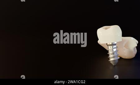 rendering 3d di un impianto di denti e denti umani sani su sfondo nero Foto Stock