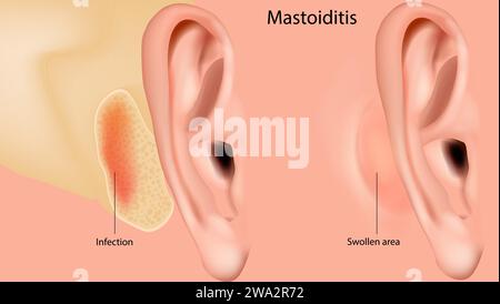 Mastoidite. Infiammazione del rivestimento mucoso dell'antro mastoide e del sistema di cellule dell'aria mastoide all'interno del processo mastoideo. Medico Illustrazione Vettoriale