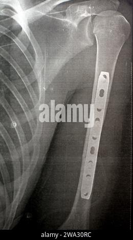 Radiografia semplice che mostra frattura dell'omero sinistro dell'albero intermedio trasversale causata da un trauma diretto in un incidente stradale, gestito da riduzione aperta e fissa interna Foto Stock