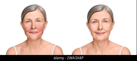 Prima e dopo il trattamento con rosacea. Foto di una donna su sfondo bianco. Collage che mostra pelle colpita e sana Foto Stock