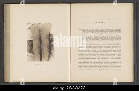 Paziente che soffre di malattia della pelle 'purpura simplex', c. 1870 - in o prima 1881 stampa fotomeccanica New York (città) carta collotipo pelle e malattie veneree. gambe Foto Stock