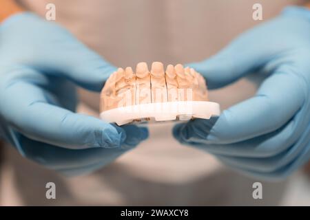 Lingotto dentale per un'ulteriore correzione futura dei denti e del gusto in una clinica odontoiatrica. Primo piano del lingotto dentato tenuto dal medico nei guanti Foto Stock