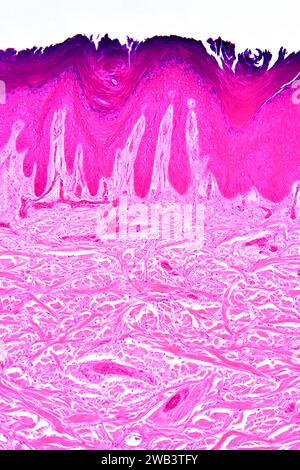 Epitelio squamoso stratificato dalla pelle umana della mano che mostra epidermide cheratinizzata e derma con tessuti connettivi. X75 a 10 cm di larghezza. Foto Stock