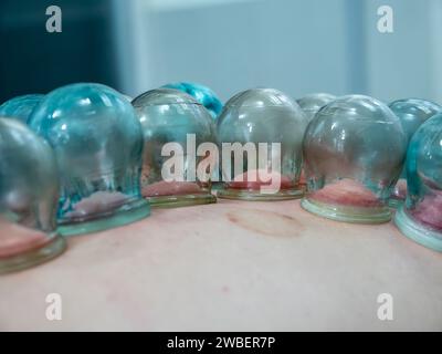 Vasetti di vetro sulla pelle posteriore del paziente. Coppettazione sotto vuoto antica forma di medicina alternativa. Medicina cinese. Foto Stock