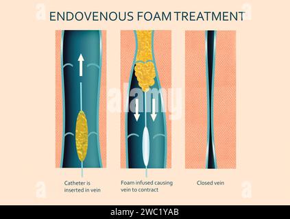 Vene varicose. Trattamento con schiuma endovenosa. Quando viene iniettata all'interno di una vena, la microschiuma sposta il sangue creando un migliore contatto con la parete venosa. Foto Stock
