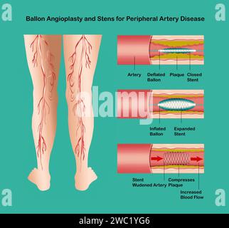 Diagramma che mostra l'angioplastica per l'illustrazione della malattia dell'arteria periferica. Concetto di pelle secca, anziani, vene varicose e TVP . Foto Stock