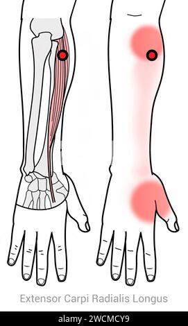 Estensore Carpi Radialis: Punti trigger miofasciali e punti di dolore associati Foto Stock