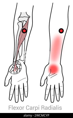 Flessore Carpi Radialis: Punti trigger miofasciali e punti di dolore associati Foto Stock