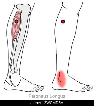 Peroneus Longus: Punti di attivazione miofasciali e punti di dolore associati Foto Stock