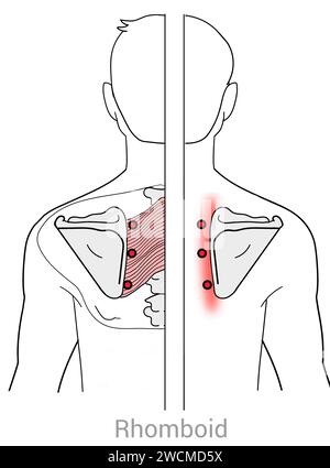 Romboide: Punti trigger miofasciali e punti di dolore associati Foto Stock