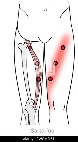 Sartorius: Punti trigger miofasciali e punti di dolore associati Foto Stock