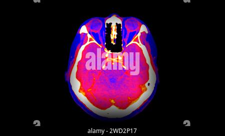 CT Brain Perfusion (perfusione cerebrale TC) o CT scan image (immagine di scansione TC) della vista assiale cerebrale . Foto Stock