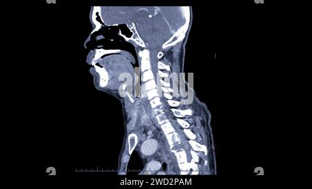 Una scansione TC della vista sagittale del collo per la tecnica diagnostica è essenziale per la valutazione delle vertebre cervicali, dei tessuti molli e per il rilevamento delle anomalie Foto Stock