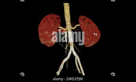 L'arteria renale CTA 3D è una procedura di imaging medico che utilizza scansioni TC per esaminare le arterie renali fornisce immagini dettagliate del suppl dei vasi sanguigni Foto Stock