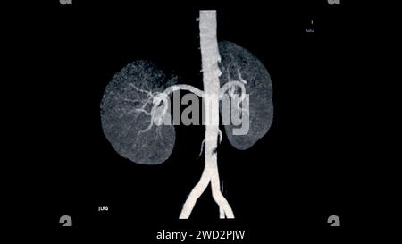 L'arteria renale CTA 3D è una procedura di imaging medico che utilizza scansioni TC per esaminare le arterie renali fornisce immagini dettagliate del suppl dei vasi sanguigni Foto Stock