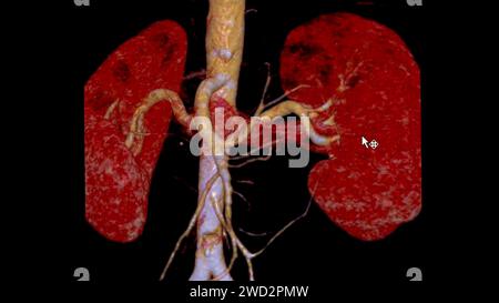 L'arteria renale CTA 3D è una procedura di imaging medico che utilizza scansioni TC per esaminare le arterie renali fornisce immagini dettagliate del suppl dei vasi sanguigni Foto Stock