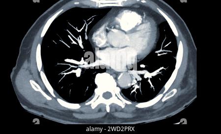 CTPA o CTA arteria polmonare. Questa tecnica di imaging offre una visione chiara delle arterie polmonari, favorendo la diagnosi di embolia polmonare, vas Foto Stock