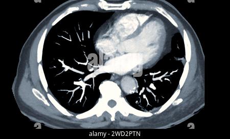 CTPA o CTA arteria polmonare. Questa tecnica di imaging offre una visione chiara delle arterie polmonari, favorendo la diagnosi di embolia polmonare, vas Foto Stock