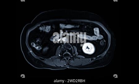 La risonanza magnetica della vista assiale superiore dell'addome è una tecnica di imaging non invasiva che fornisce immagini dettagliate di organi come fegato, pancreas e reni. Foto Stock