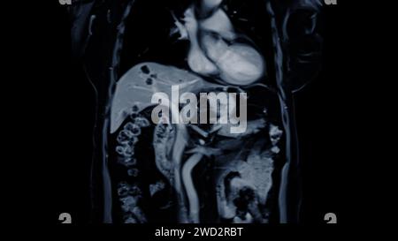 La risonanza magnetica della vista coronale dell'addome superiore è una tecnica di imaging non invasiva che fornisce immagini dettagliate di organi come fegato, pancreas e reni. Foto Stock