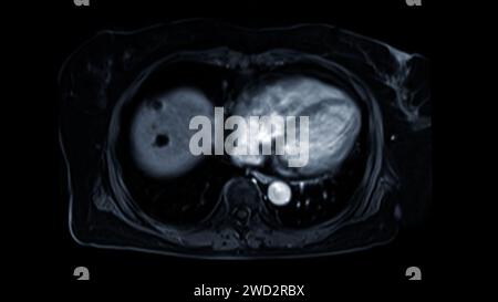 La risonanza magnetica della vista assiale superiore dell'addome è una tecnica di imaging non invasiva che fornisce immagini dettagliate di organi come fegato, pancreas e reni. Foto Stock