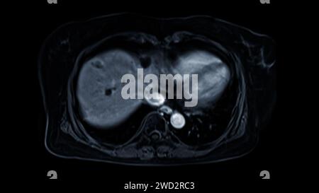 La risonanza magnetica della vista assiale superiore dell'addome è una tecnica di imaging non invasiva che fornisce immagini dettagliate di organi come fegato, pancreas e reni. Foto Stock