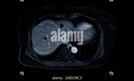 La risonanza magnetica della vista assiale superiore dell'addome è una tecnica di imaging non invasiva che fornisce immagini dettagliate di organi come fegato, pancreas e reni. Foto Stock