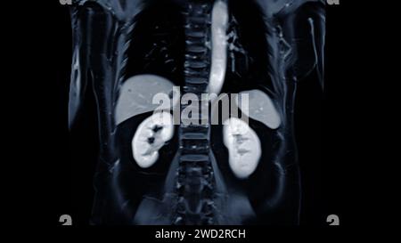 La risonanza magnetica della vista coronale dell'addome superiore è una tecnica di imaging non invasiva che fornisce immagini dettagliate di organi come fegato, pancreas e reni. Foto Stock
