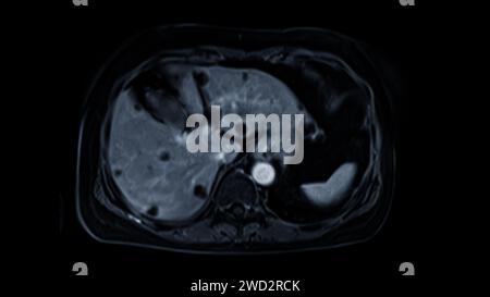 La risonanza magnetica della vista assiale superiore dell'addome è una tecnica di imaging non invasiva che fornisce immagini dettagliate di organi come fegato, pancreas e reni. Foto Stock