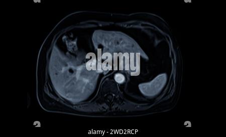 La risonanza magnetica della vista assiale superiore dell'addome è una tecnica di imaging non invasiva che fornisce immagini dettagliate di organi come fegato, pancreas e reni. Foto Stock