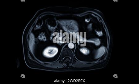 La risonanza magnetica della vista assiale superiore dell'addome è una tecnica di imaging non invasiva che fornisce immagini dettagliate di organi come fegato, pancreas e reni. Foto Stock