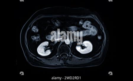 La risonanza magnetica della vista assiale superiore dell'addome è una tecnica di imaging non invasiva che fornisce immagini dettagliate di organi come fegato, pancreas e reni. Foto Stock