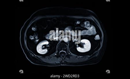 La risonanza magnetica della vista assiale superiore dell'addome è una tecnica di imaging non invasiva che fornisce immagini dettagliate di organi come fegato, pancreas e reni. Foto Stock