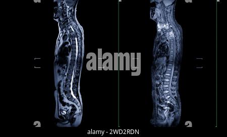Una risonanza magnetica dell'intera immagine della colonna vertebrale è una rappresentazione visiva completa prodotta tramite l'imaging a risonanza magnetica, che fornisce informazioni dettagliate su Foto Stock