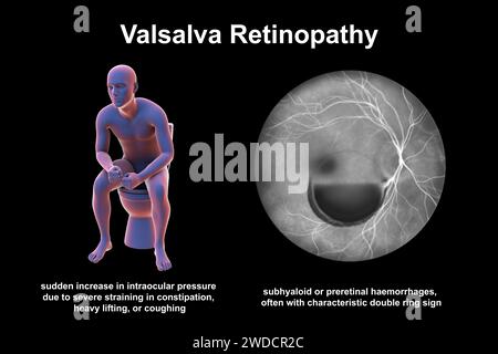 Retinopatia Valsava, illustrazione Foto Stock