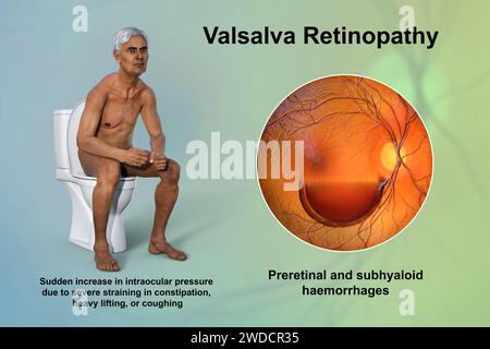 Retinopatia Valsava, illustrazione Foto Stock