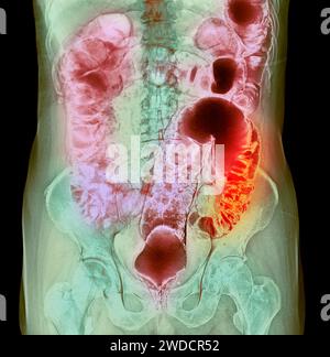 Diverticola del colon, raggi X. Foto Stock