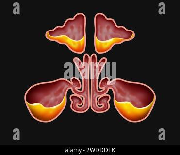 Sinusite e malattia da infezione sinusale come congestione nasale come malattia di blocco della cavità con un naso congestionato pieno di muco o pus. Foto Stock