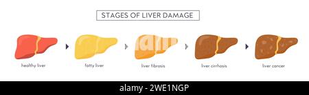 Stadi di danno epatico non alcolico. Sano, grasso, steatosi, NASH, fibrosi, cirrosi, cancro. Infografica medica della malattia del fegato. Banner vettoriale Illustrazione Vettoriale