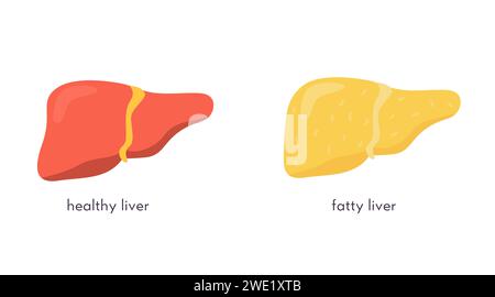 Stadi di danno epatico non alcolico. Organo umano grasso sano e malsano. Malattie del fegato. Illustrazione vettoriale in stile cartone animato piatto isolato su whi Illustrazione Vettoriale