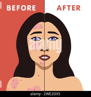 Immagine vettoriale di una donna discreta prima e dopo l'acne trattamento della pelle illustrazione minimalista Illustrazione Vettoriale