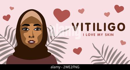 Banner su vitilingo malattia della pelle con giovane bella donna musulmana, illustrazione vettoriale minimalista, testo amo la mia pelle Illustrazione Vettoriale