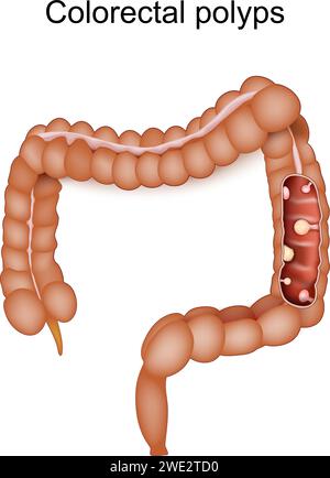 Polipi colorettali e cancro del colon. Intestino crasso umano con conseguenza di malattia infiammatoria intestinale. Illustrazione vettoriale Illustrazione Vettoriale