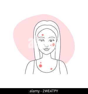 Giovane donna triste con pelle pimply sul viso prima di trattamento acne illustrazione vettoriale Illustrazione Vettoriale