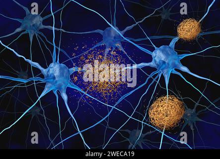 Terapia mirata all'amiloide come placche costituite da ammassi anomali di frammenti proteici che si accumulano tra le cellule nervose distrutte o disciolte Foto Stock