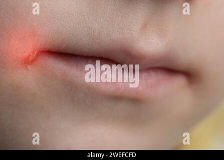 Dolore e prurito agli angoli delle labbra della bocca di una ragazza. Convulsioni sulla pelle, malattia dermatologica batterica. Infezione da herpes, cheil angolare Foto Stock