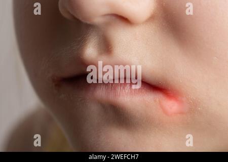 Convulsioni agli angoli delle labbra della bocca di un bambino. Malattia batterica di infiammazione degli angoli delle labbra. Stomatite angolare con ridotta Foto Stock