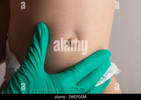 Le mani del medico in guanti medici verdi esaminano un'ernia ombelicale in un bambino, primo piano. Problemi Foto Stock