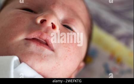 Brufoli allergici in un neonato sul viso. Patogenesi, acne dei neonati, primo piano Foto Stock