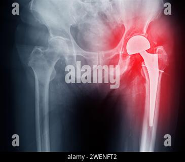 Una radiografia rivela entrambe le articolazioni dell'anca con ARTROPLASTICA DELL'ANCA TOTALE, dimostrando il successo della procedura chirurgica e fornendo un testamento visivo al Foto Stock